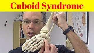 Cuboid Syndrome Mysterious Foot Pain [upl. by Bore]