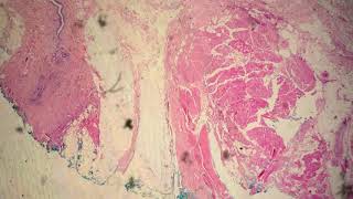 Acinic Cell Carcinoma [upl. by Nahallac]