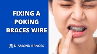 How to Fix a Long Wire Poking from Braces StepbyStep Demonstration [upl. by Cedar]