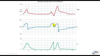 Patient ventilator Asynchrony Double Triggering [upl. by Middle]