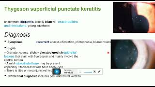 thygeson superficial punctate keratitis [upl. by Ahseikram]