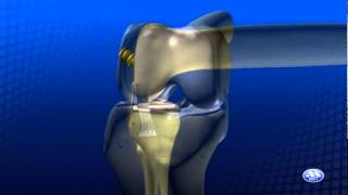 Reconstrucão do Ligamento Cruzado Anterior [upl. by Felske835]