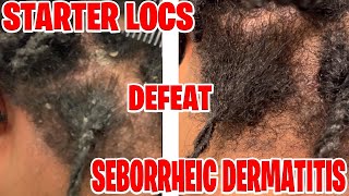 How I DefeatedTreated Seborrheic Dermatitis Managing With Starter Locs JET Loc Journey [upl. by Savanna]