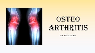 Ortho Osteoarthritis  risk factors causes signs amp symptoms xray findings treatment [upl. by Ahseela]