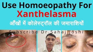 Xanthelasma Homeopathic medicine for Xanthelasma [upl. by Gorrono]