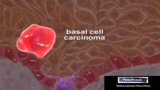 Basal Cell Carcinomas Medical Animation Video 3D [upl. by Ellenahc]