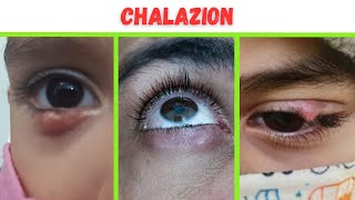 Chalazion  Photos Causes Diagnosis and Treatment [upl. by Morse]