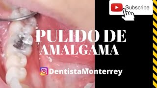 AMALGAMA Dental 👅 PULIDO [upl. by Rie]