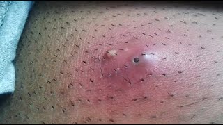 Big Cystic Acne Blackheads Extraction Blackheads amp Milia Whiteheads Removal Pimple Popping [upl. by Vonnie]