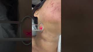 co2 fractional laser treatment [upl. by Maryly]