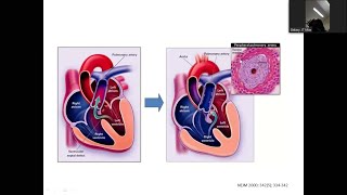 Eisenmenger Syndrome by Dr Abdullah Shahriar sir [upl. by Soll396]