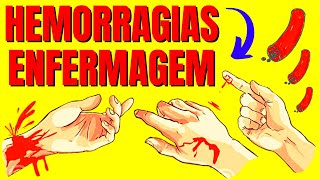 💥HEMORRAGIAS EM ENFERMAGEM  QUESTÃO DE CONCURSO  QUIZ ENFERMAGEM [upl. by Doralynn]