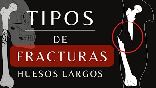 Tipos de Fracturas  Osteología  Anatomia y Fisiología [upl. by Ahidam]