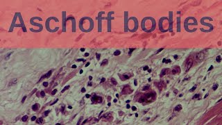 What are Aschoff Bodies  Pathology mini tutorials [upl. by Anana]