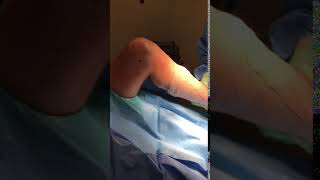 Knee Motion Before Arthroscopic Removal of Arthrofibrosis [upl. by Anahahs]