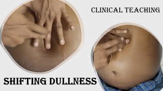 SHIFTING DULLNESS How to Demonstrate mbbs clinical liver [upl. by Mariejeanne260]