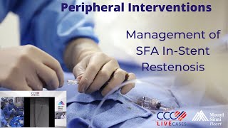 Management of SFA InStent Restenosis [upl. by Aisenet190]