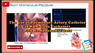 The Use of Pulmonary Artery CatheterPAC┊SWANGanz┊Medical┊Nurse┊Doctor┊ECMO┊Heart┊IABP┊Impella [upl. by Charlene]