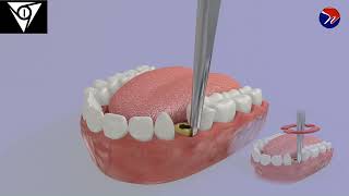 M1 Atraumatic ankylosed root extraction using pre elevator 1 [upl. by Limak600]