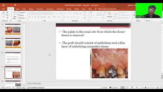 MUCOGINGIVAL SURGERY BY Dr ARJUN M R  DEPARTMENT OF PERIODONTICS [upl. by Alrep316]