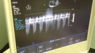 McConnells sign due to massive pulmonary embolism [upl. by Lachman]