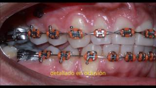 Cierre de Diastema Central y Mesialización de Molares [upl. by Ylatan784]