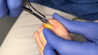 Usuwanie wrastającego fragmentu paznokcia  Ingrown toenail removal [upl. by Lukash536]