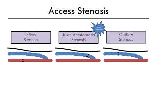 Hemodialysis Access 101 04  Part 1 Access Stenosis [upl. by Sinai473]