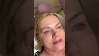 Plasma com lifting facial veja o resultado [upl. by Isac173]