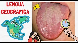 LENGUA GEOGRÁFICA  QUÉ ES Y CÓMO SE CURA [upl. by Amata]