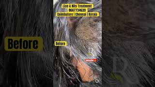 Lice nits removal treatment  lice treatment  lice removal  lice how to remove the nits from hair [upl. by Stauffer614]