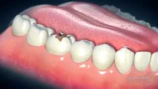 Dental Crowns Everything You Need to Know [upl. by Eilyr]