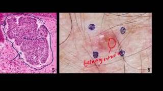 Introduction to NMSC Skin Cancer 2 Basal Cell Cancer BCC and Squamous Cell Cancer SCC [upl. by Aicilaana]