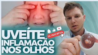 Uveíte O que é essa inflamação ocular [upl. by Adiraf989]