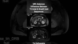 MRI Abdomen  Difference Between T2 and T2 Breath hold Sequences MRI abdomen anatomy [upl. by Furnary]