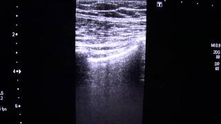 Pleural Sliding SignMP4 [upl. by Franchot837]