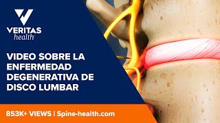 Video sobre la enfermedad degenerativa de disco lumbar [upl. by Nawud]