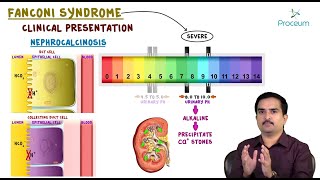 Fanconi syndrome  Etiology Clinical Features Pathology Diagnosis and Treatment usmle pathology [upl. by Alcina811]