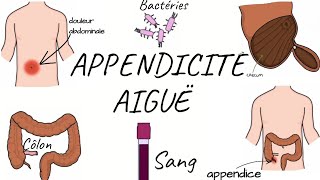 LAPPENDICITE AIGUË physiopathologie symptômes diagnostic traitement [upl. by Soilisav]