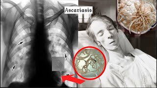 The HORRIFIC History of Ascariasis [upl. by Elboa424]