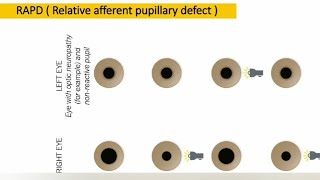 Relative afferent pupillary defect  RAPD  explained [upl. by Sonitnatsnok]