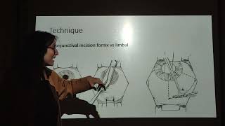 Surgery Module  Trabeculectomy  Prof Rasha Eltanamly [upl. by Idette]