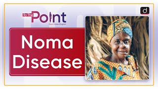 Noma Disease Neglected Tropical Diseases  To The Point Drishti IAS English [upl. by Jabe]