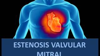 Estenosis valvular mitral  Fisiopatología [upl. by Nylrehc]