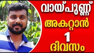 വായ്പ്പുണ്ണ് ഒരു ദിവസം കൊണ്ട് മാറ്റാന്‍ Mouth Ulcer Home Remedy [upl. by Derick]