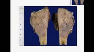 Histopathology Bone Osteosarcoma [upl. by Coppola37]