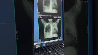 HRCT LUNGS SCANNING 🫁 [upl. by Nwahsar783]