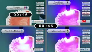 Direct restoration UNIVERSAL BOND II in comparison  TOKUYAMA DENTAL [upl. by Talia68]