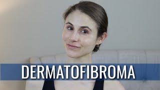 DERMATOFIBROMA WHAT IS IT HOW IS IT TREATED  DR DRAY [upl. by Ellehcar]