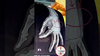 Metacarpal fractureहथेली के हड्डी मै तारDr Irfan Siddiqui orthopaedicbestbone anatomyfracture [upl. by Tore]